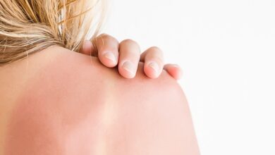 طرق علاج حروق الشمس طبيعياً