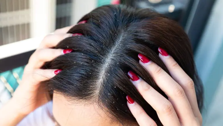 5 علاجات منزلية للتخلص من قشرة الشعر بسرعة