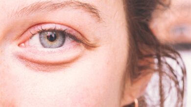 علاج الانتفاخ تحت العين طبيعياً