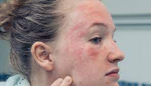 التهاب الجلد التأتبي في الوجه
