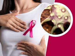ما هو سرطان الثدي المنتشر