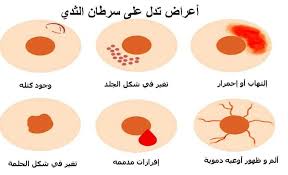 أعراض سرطان الثدي بالصور