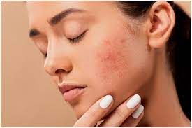 الطفح الجلدي الشتوي – الأسباب والعلاج
