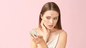 7 علاجات منزلية لإزالة البثور في الصيف