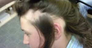 طرق علاج الشعر الخفيف