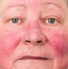 علاج الوردية