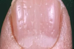 التهاب المفاصل الصدفي بالصور