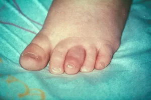 التهاب المفاصل الصدفي بالصور