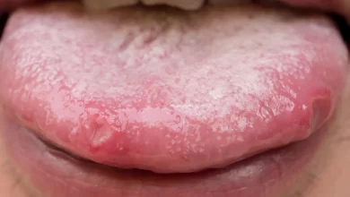 أسباب التهاب اللسان وعلاجه