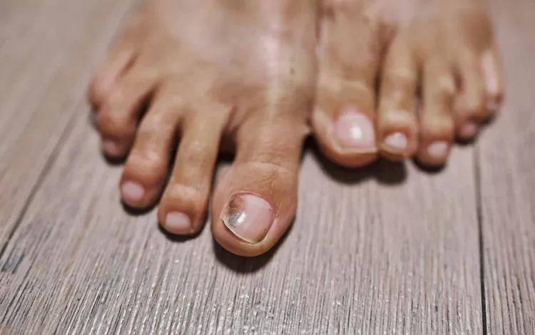 أسباب سواد أظافر القدم