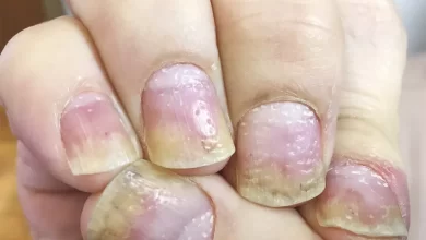 أسباب ظهور حفر في الأظافر