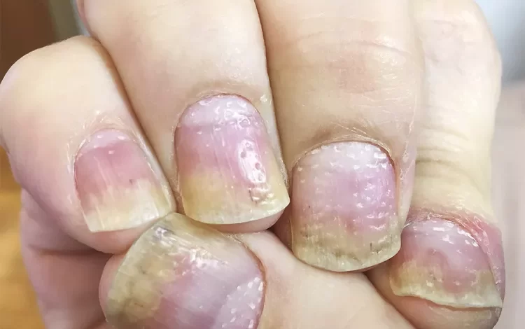 أسباب ظهور حفر في الأظافر