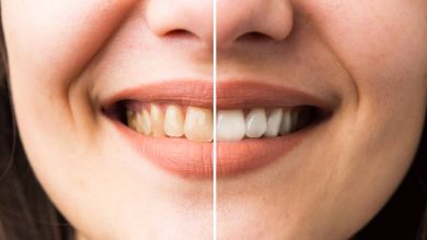كيفية تبييض الأسنان الصفراء طبيعيًا