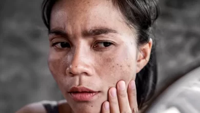 البقع الشمسية على الجلد